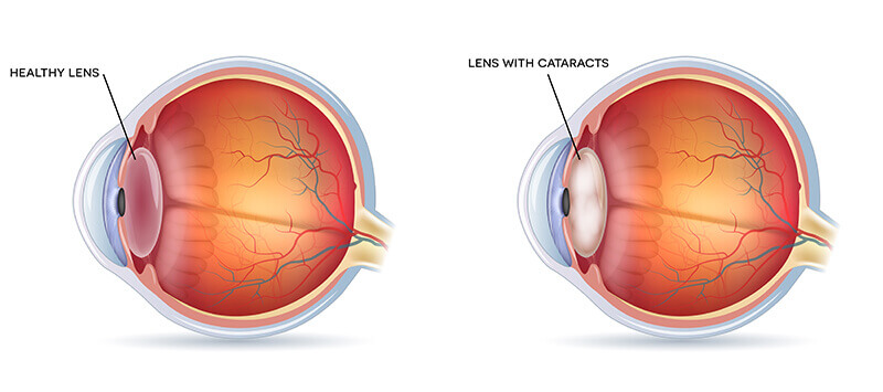 Chart showing a healthy eye compared to one that has a cataract
