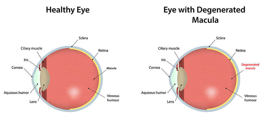 Chart Showing a Healthy Eye Compared to One With Macular Degeneration