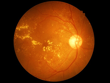 Scan of an Eye with Macular Degeneration