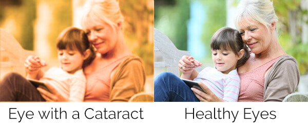 Chart showing what its like to see with a cataract compared to a healthy eye
