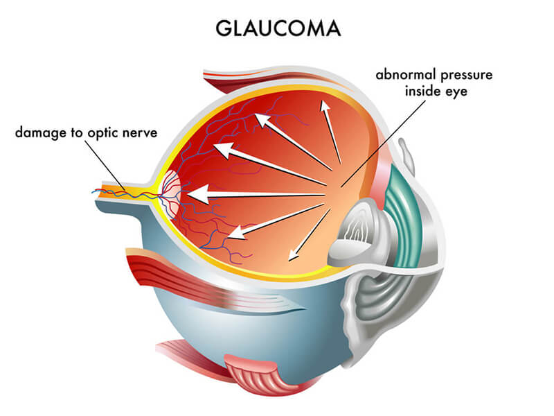 Chart Showing How Glaucoma Reacts in the Eye